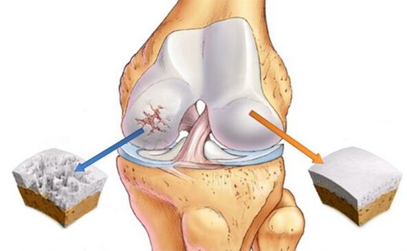 A térdízület (bal) és a normál porc (jobb) osteoarthritise
